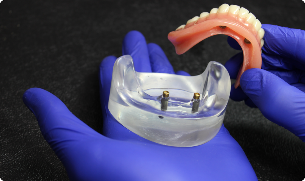 Denture-Implants