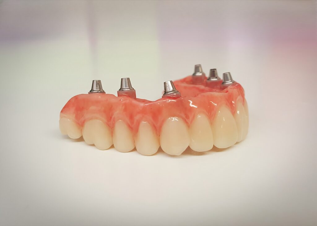 Denture implants